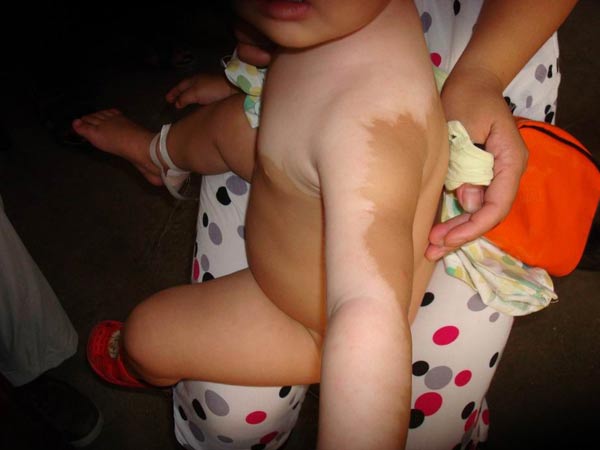 婴幼儿白癜风的病因是哪些